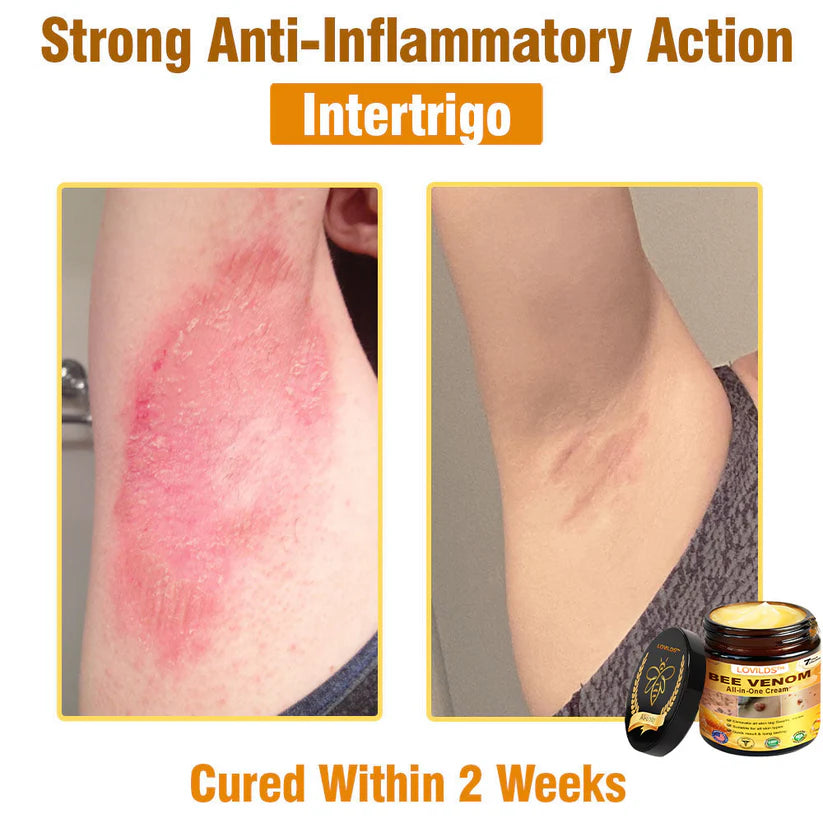 𝐋𝐎𝐕𝐈𝐋𝐃𝐒™ 𝐁𝐞𝐞 𝐕𝐞𝐧𝐨𝐦 𝐀𝐥𝐥-𝐢𝐧-𝐎𝐧𝐞 𝐂𝐫𝐞𝐚𝐦–🌸 Anti-aging,Hydrating, Skin Repair, Even Tone, Acne and Dark Spot Treatment, Wart and Mole Removal, Psoriasis Relief