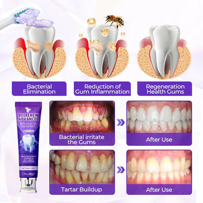 Oveallgo® BeeRenew Advanced Gum Healing Toothpaste