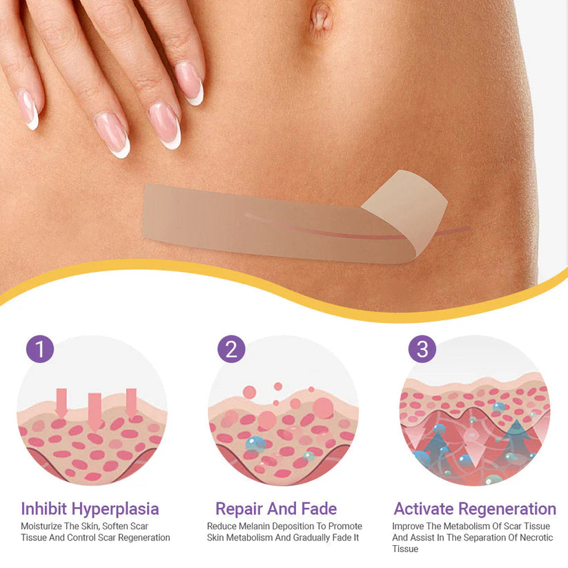 ✅Official Store | Hyaluronic Acid Nano Microneedle Repair Tape🏥(Treatment of old and new scars, reduction of surgical scars, stretch marks, keloids, acne, burns, warts, dermatomes and varicose veins)
