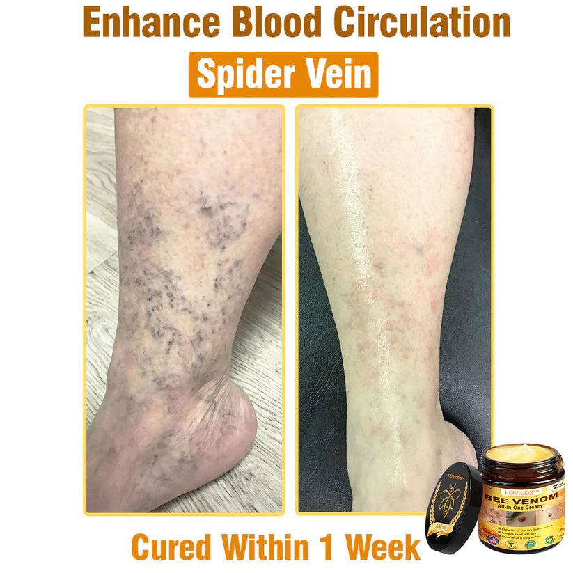 𝐋𝐎𝐕𝐈𝐋𝐃𝐒™ 𝐁𝐞𝐞 𝐕𝐞𝐧𝐨𝐦 𝐀𝐥𝐥-𝐢𝐧-𝐎𝐧𝐞 𝐂𝐫𝐞𝐚𝐦–🌸 Anti-aging,Hydrating, Skin Repair, Even Tone, Acne and Dark Spot Treatment, Wart and Mole Removal, Psoriasis Relief