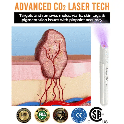 BLACK FRIDAY 70% OFF-Zynkoro VelvetSkin+Series ⚔️All-in-One Laser Eraser Pen🖊️ (🔬Powered by CO₂ laser technology – effectively removes moles, warts, skin tags, pigmentation spots, and other skin imperfections)