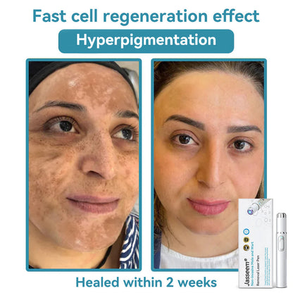 Medical-Grade Laser Pen 💕 (Powered by CO₂ laser technology – effectively removes moles, warts, skin tags, pigmentation spots, and other skin imperfections)🏆