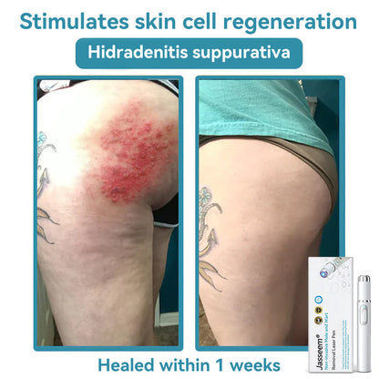 Medical-Grade Laser Pen 💕 (Powered by CO₂ laser technology – effectively removes moles, warts, skin tags, pigmentation spots, and other skin imperfections)🏆