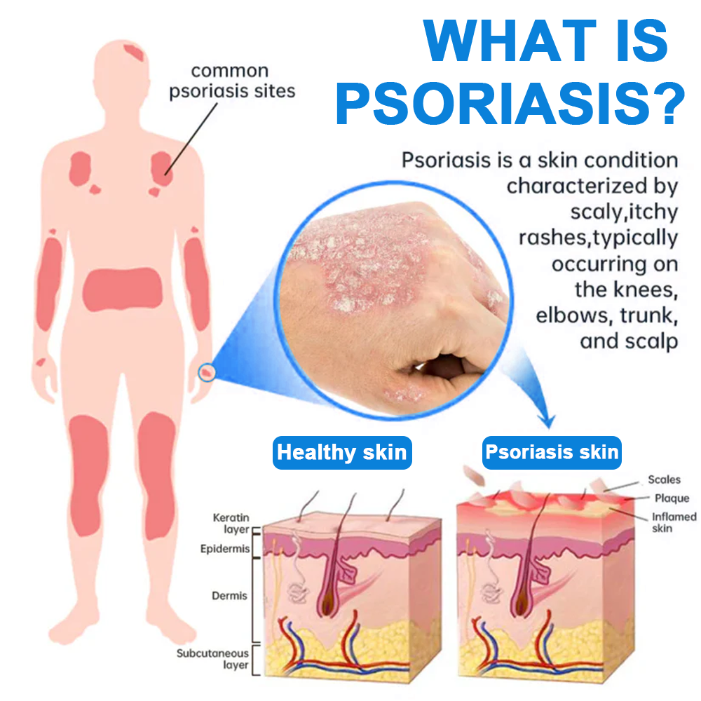 ✅ Official Store: Magnesium Herbal Psoriasis Spray⚕️FDA Approved (Relieves psoriasis and eczema, treats rosacea and acne, alleviates psoriatic arthritis)