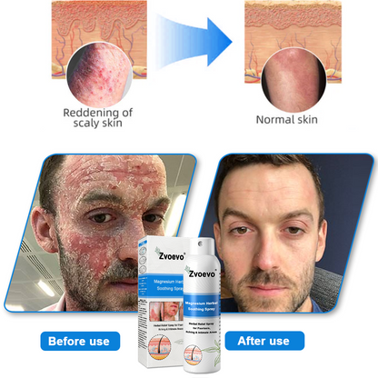 ✅ Official Store: Magnesium Herbal Psoriasis Spray⚕️FDA Approved (Relieves psoriasis and eczema, treats rosacea and acne, alleviates psoriatic arthritis)