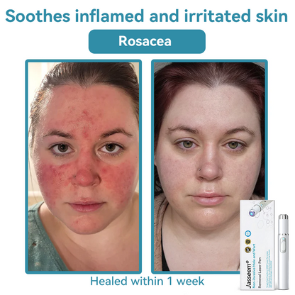 Medical-Grade Laser Pen 💕 (Powered by CO₂ laser technology – effectively removes moles, warts, skin tags, pigmentation spots, and other skin imperfections)🏆