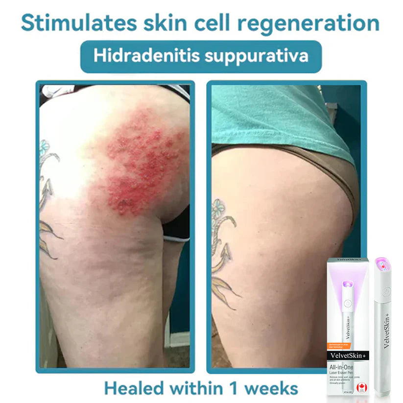 BLACK FRIDAY 70% OFF-Zynkoro VelvetSkin+Series ⚔️All-in-One Laser Eraser Pen🖊️ (🔬Powered by CO₂ laser technology – effectively removes moles, warts, skin tags, pigmentation spots, and other skin imperfections)