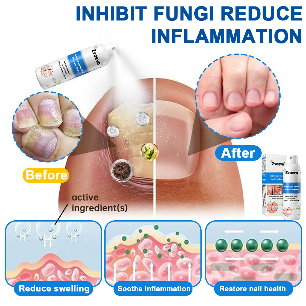 ✅ Official Store: Magnesium Herbal Psoriasis Spray⚕️FDA Approved (Relieves psoriasis and eczema, treats rosacea and acne, alleviates psoriatic arthritis)